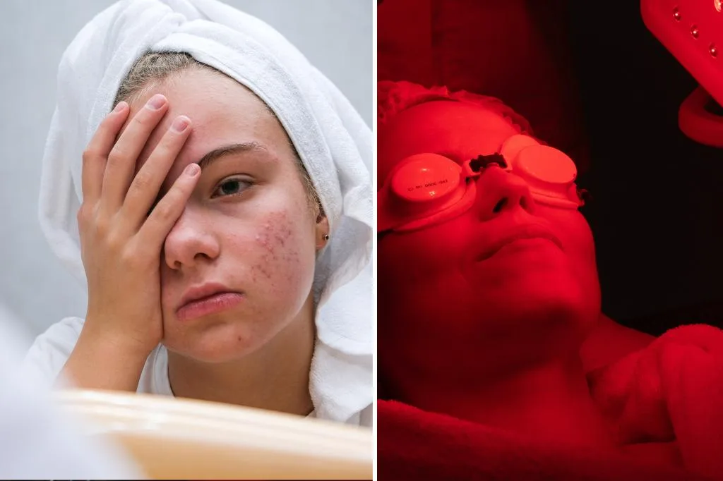 La thérapie à la lumière rouge à domicile peut-elle vraiment guérir l'acné?
